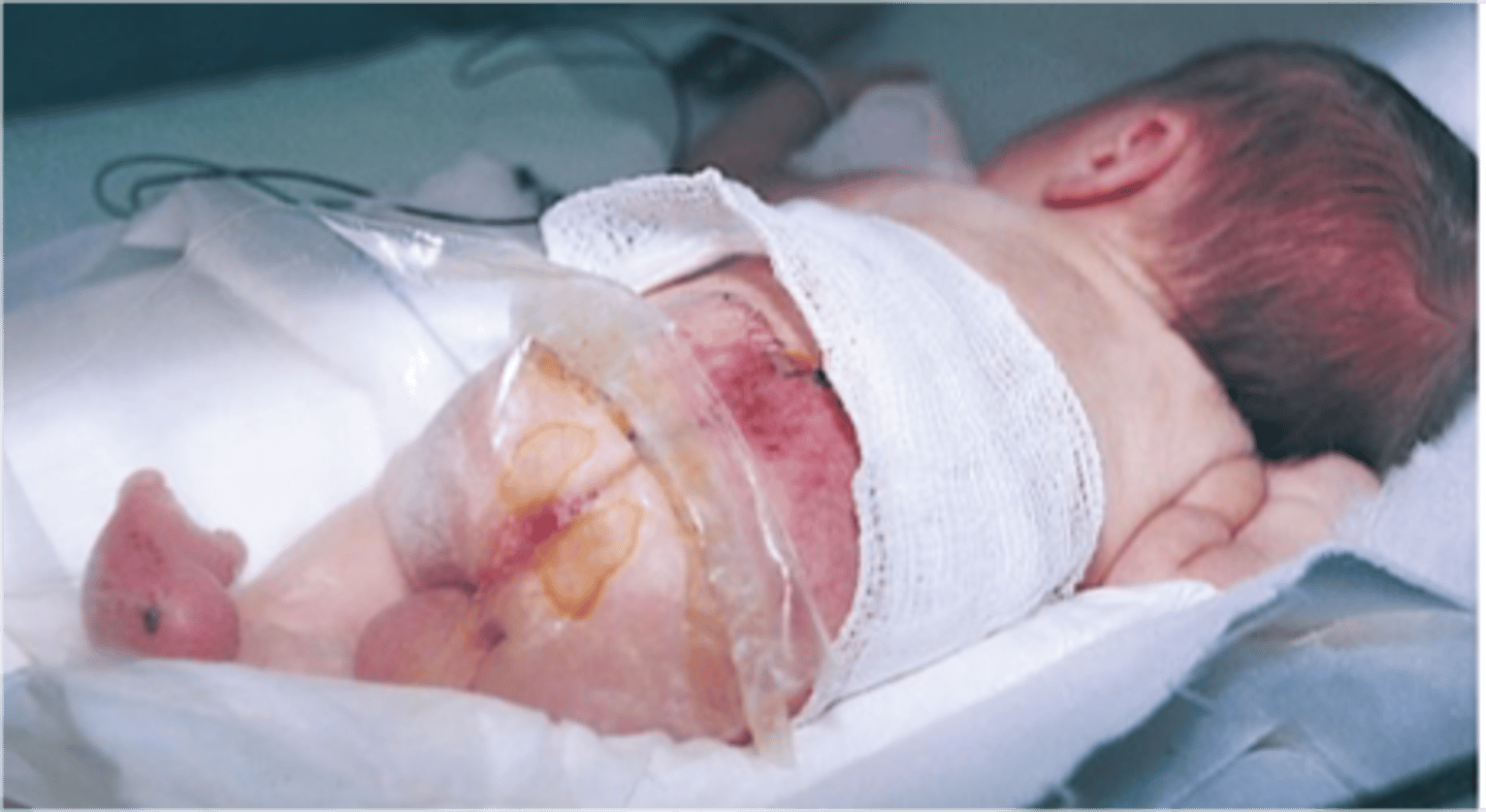 <p>•Failure of the osseous spine to close.</p><p>•Neural tube defects (NTDs) are present at birth and affect the CNS and osseous spine.</p><p>•Meningocele: The sac contains spinal fluid and meninges.</p><p>•Myelomeningocele: The sac contains spinal fluid, meninges, and nerves.</p><p>Risk Factors</p><p>•Medications/substances taken during pregnancy</p><p>•Maternal malnutrition</p><p>•Insufficient folic acid intake during pregnancy</p><p>•Exposure to radiation or chemicals during pregnancy</p><p>Procedures</p><p>•Neurosurgery, neurology, urology, orthopedics, pediatrics, physical therapy, occupational therapy, and social services</p><p>•Closure of a myelomeningocele sac is done as soon as possible to prevent complications of injury and infection.</p><p>•Protect the sac from injury.</p><p>•Place infant in a warmer, without clothing.</p><p>•Apply a sterile, moist, nonadhering dressing with 0.9% sodium chloride on the sac, changing it every 2 hr.</p><p>•Inspect the sac closely for leaks, irritation, abrasions and localized indications of infection.</p><p>•Assess for systemic indications of infection (fever, irritability, and lethargy).</p><p>•Place infant in the prone position with hips flexed, legs abducted.</p><p>•Administer IV antibiotic as prescribed.</p><p>•Avoid rectal temperatures.</p><p>•Avoid cuddling or putting pressure on the sac.</p><p>Complications</p><p>•Skin Ulcerations</p><p>•Latex Allergy</p><p>•Increased intracranial pressure</p><p>•Caused by shunt malfunction or hydrocephalus.</p><p>•Bladder Issues</p><p>•Orthopedic Issues</p><p>(pic is of a repaired myelomeningocele)</p>