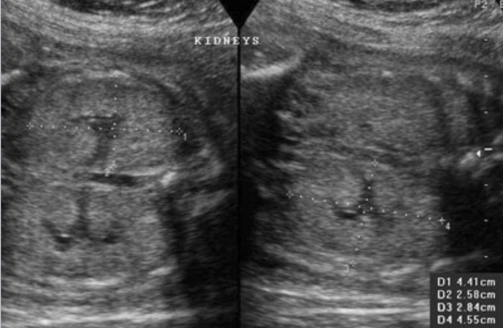 <ul><li><p>autosomal recessive</p></li><li><p>Symmetric kidney enlargement</p></li><li><p>Most severe cases = renal failure</p></li></ul><p></p>