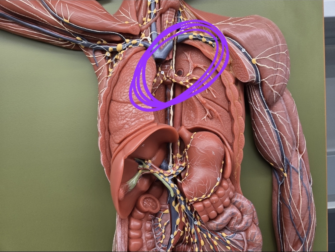 <p><strong>Thoracic duct</strong></p><p>Deposits in Left subclavian vein</p>