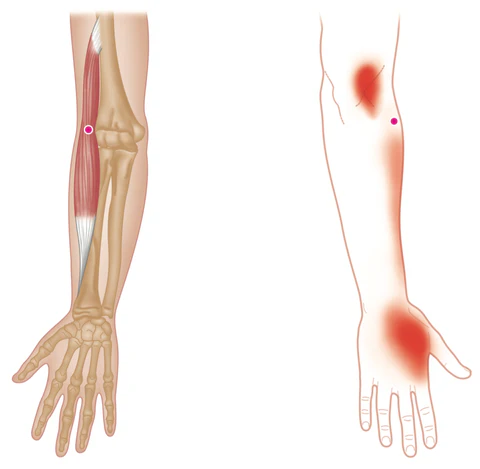 <ul><li><p>origin: humerus </p></li><li><p>insertion: radius</p></li><li><p>action: flexes forearm at elbow </p></li></ul><p></p>