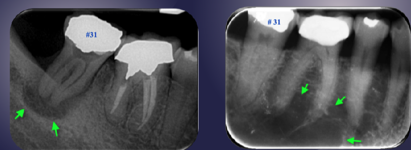 <p>differentiate the pathology of the 2 images </p>
