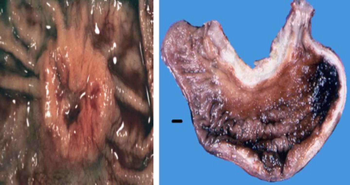 <p>malignant tumor of glandular epithelia</p>