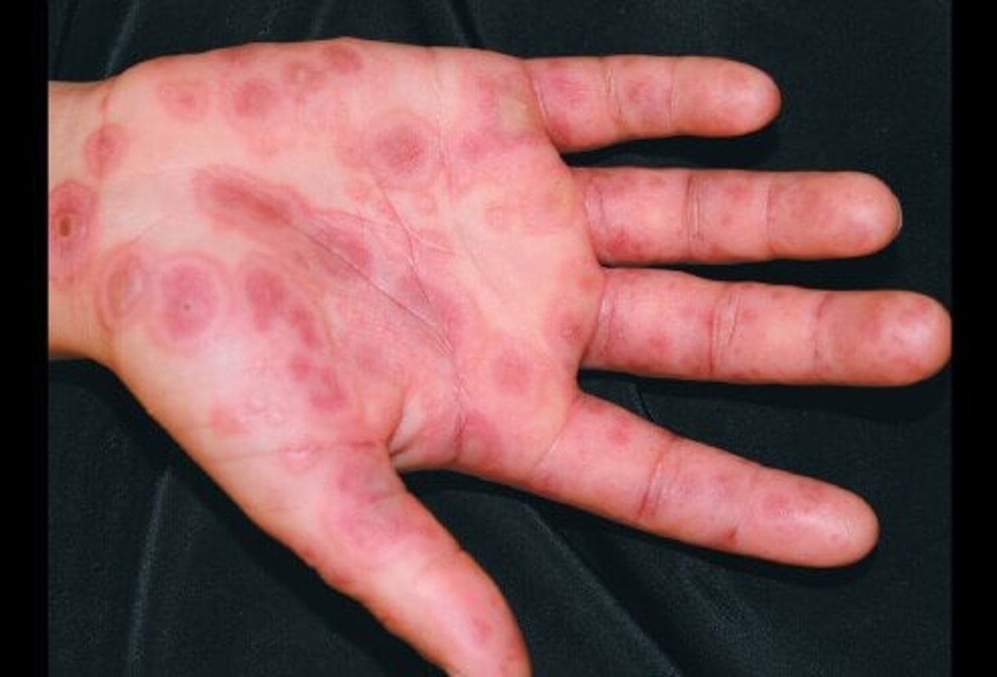 <p>classic target lesion</p>