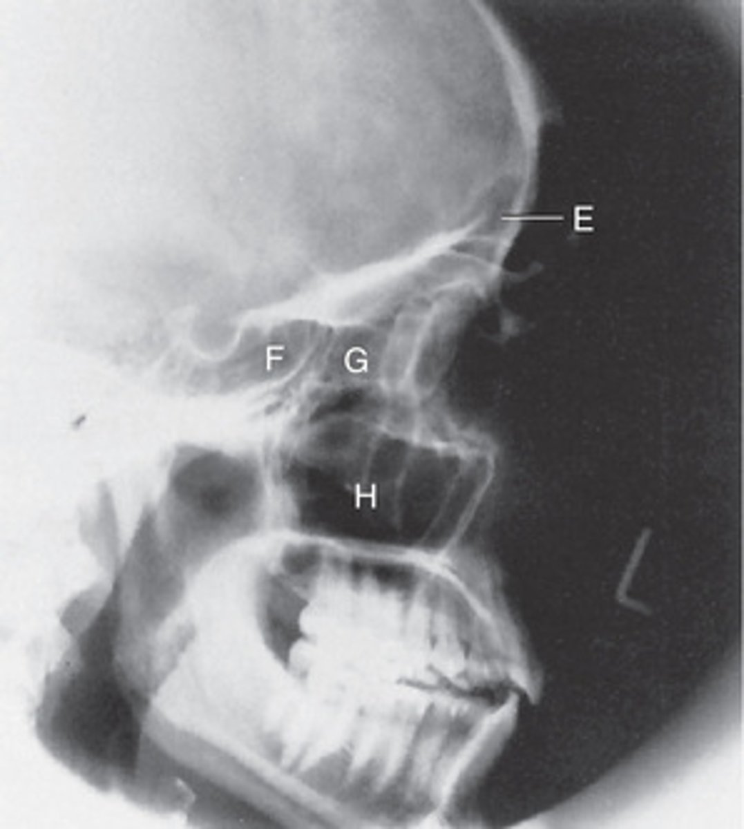 <p>E. Frontal sinuses</p><p>F. Sphenoid sinus</p><p>G. Ethmoid sinuses</p><p>H. Maxillary sinuses</p>