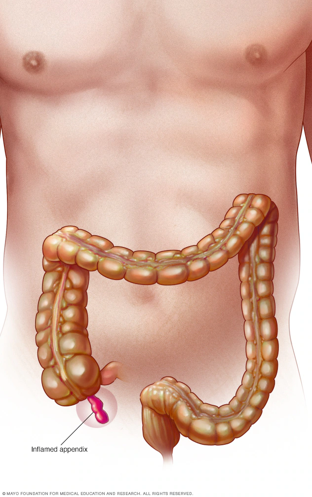 <ol><li><p>abdominal pain</p></li><li><p>nausea/vomiting</p></li><li><p>loss of appetite</p></li><li><p>fever - low grade, high grade = ruptured</p></li><li><p>constipation or diarrhea</p></li><li><p>belly bloating/gas</p></li></ol><p></p>