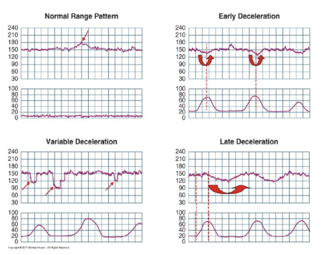 <p>onset</p><ul><li><p>gradual</p></li><li><p>abrupt</p></li></ul><p>shape</p><ul><li><p>mirrors UC or V/W/U</p></li></ul><p>relationship to UC</p><ul><li><p>early, late, no relationship?</p></li></ul><p>types of deceleration</p><ul><li><p>early</p></li><li><p>late</p></li><li><p>variable</p></li><li><p>prolonged</p></li></ul>