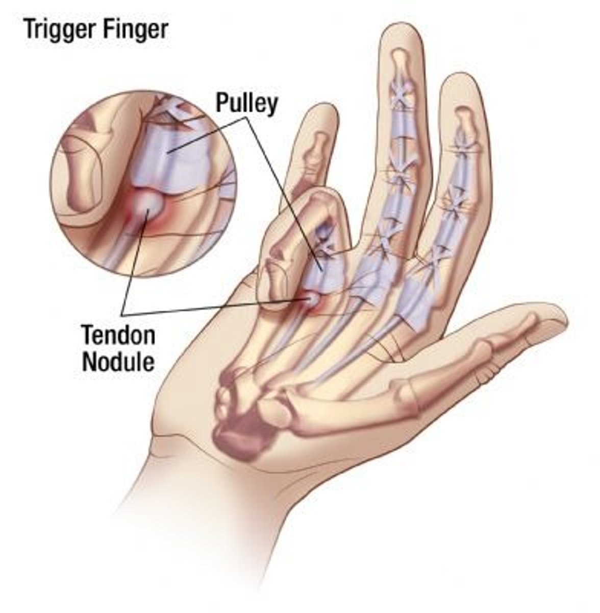 <p>- common on middle/ring finger</p><p>- inflammation created thick flexor tendon and nodule in tendon sheath</p><p>- finger locked in flexion once nodule is to large to pass</p>