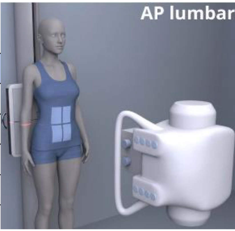 <p>SID: 40”</p><p>Air Gap: NO</p><p>Cassette Size: 14×17</p><p>Collimation: 10×17</p><p>Tube tilt: N/A</p><p>Measure through: largest dimension of abdomen</p><p>Central ray: 1.5” above iliac crest</p><p style="text-align: left">Breathing: suspend EXPIRATION</p>