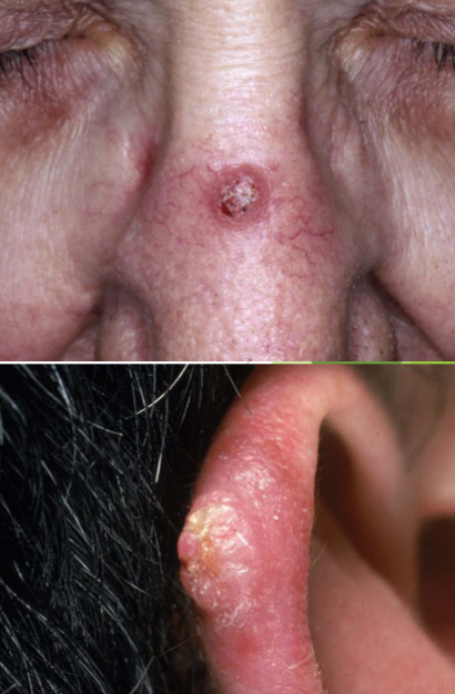<p>risk factors for squamous cell carcinoma </p>