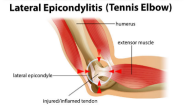 <p><strong>Elbow tendinopathy - </strong>no inflammation</p><p><span style="color: blue">(Tx: reduce load on elbow, less stretching, ensuring pads cover the elbow)</span></p>