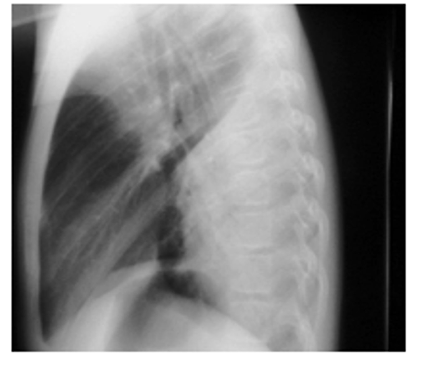 <p>oSpine sign = vertebral bodies are lighter (white) than normal</p>