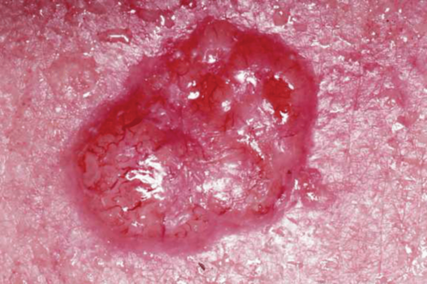 <p>Most common form of skin cancer; Originates in stratum basale due to mutations caused by overexposure to UV radiation; Virtually no metastasis and most people survive</p>