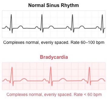 <p>heart beats too slow, bpm &lt;60</p>