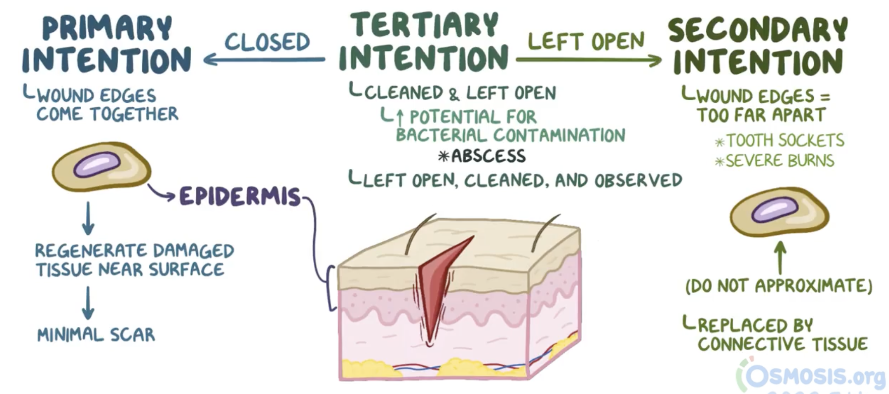 <ul><li><p><span style="font-size: calc(var(--scale-factor)*20.27px)">defect too large and contaminated</span></p></li><li><p>medical intervention</p></li><li><p>delayed primary closure:</p><ul><li><p><span style="font-size: calc(var(--scale-factor)*20.27px)">Wound is cleaned</span></p></li><li><p><span style="font-size: calc(var(--scale-factor)*20.27px)">edges debrided and kept open for 4-7 days</span></p></li><li><p><span style="font-size: calc(var(--scale-factor)*20.27px)">Secondary healing begins/granulation appears</span></p></li><li><p><span style="font-size: calc(var(--scale-factor)*20.30px)">surgically: edges brought closer</span></p></li></ul></li><li><p><span style="font-size: calc(var(--scale-factor)*20.27px)">E.g.: Tissue grafting sites, highly contaminated/infected, ischaemic/necrotic, etc.</span></p></li></ul><p></p>