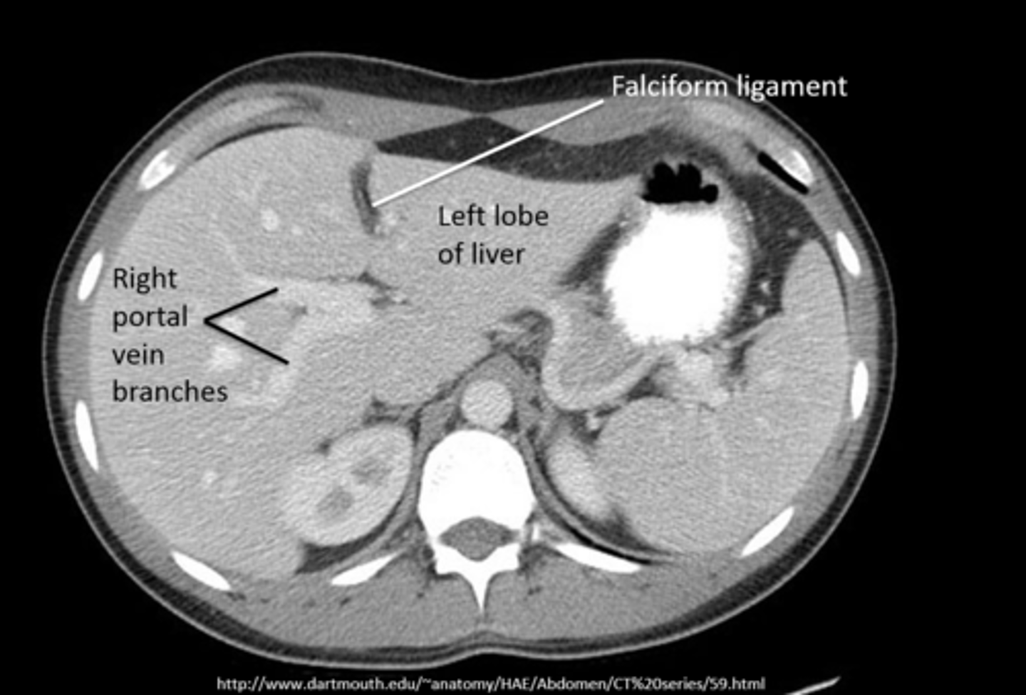 <p>xray- only shows organomegaly</p><p>CT- most common method for imaging</p><p>ultrasounds- detecting size and ascites</p><p>MRI- define tumors</p>