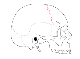 Between the frontal bone and parietal bones