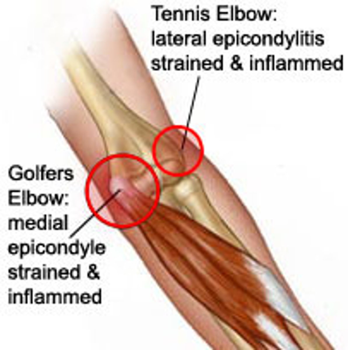 <p>• +/- Edema over lateral epicondyle</p><p>• Point tenderness to palpation over lateral epicondyle</p><p>• Pain with resisted wrist extension with elbow extension</p><p>• Decreased grip strength</p>