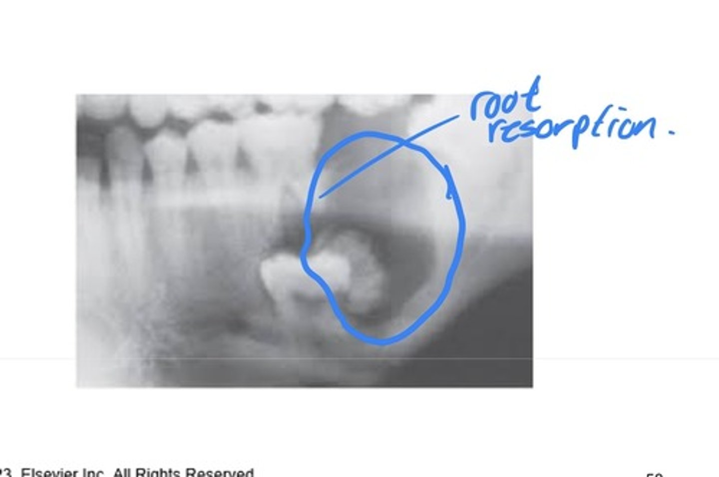 <p>Radiographically: a unilocular or multilocular radiolucency. Occurs more often in the man than max, most often in the bicuspid and molar area.</p>