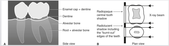 <p>x-rays passing tangentially through proximal area encounter less structure; shallow depression/concavity on M/D root surface can make area appear more radiolucent </p>