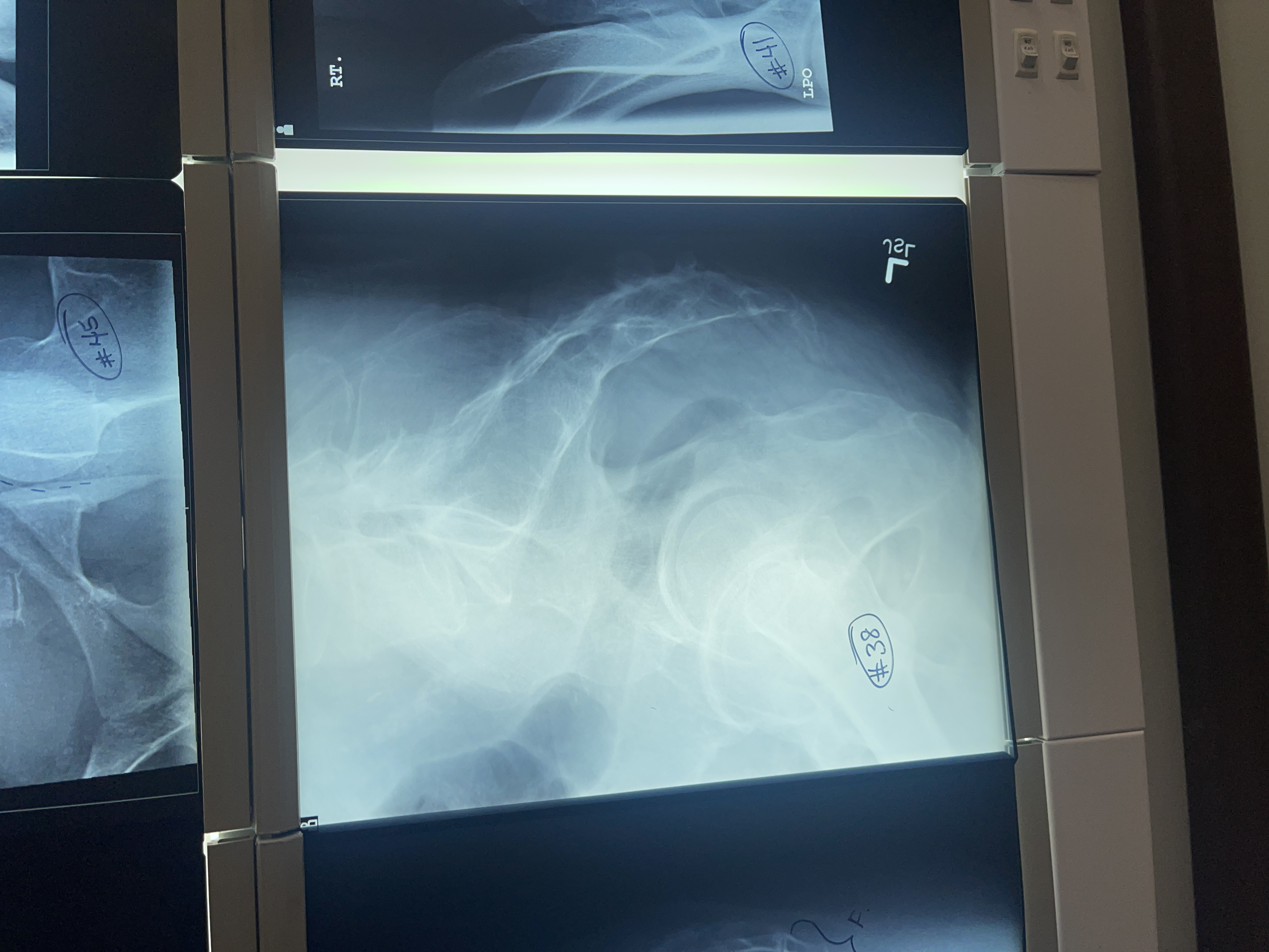 <p>What’s wrong with #38 lateral sacrum/ coccyx</p>