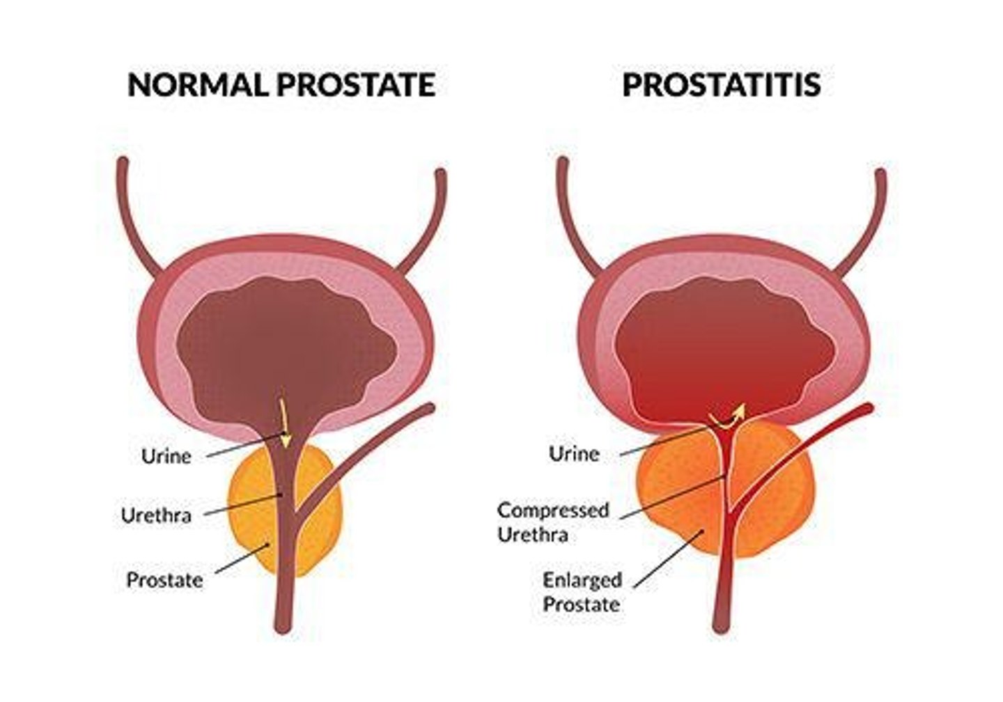 <p>Inflammation of the prostate gland; most often, prostatitis is not an infectious disease.</p>
