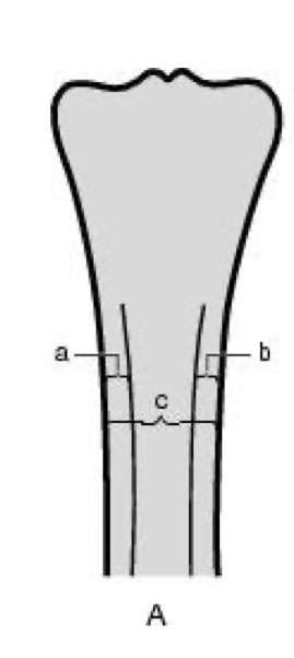 <p>how do you calculate normal cortical thickness?</p>