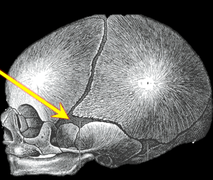 <p>Sphenoid fontanel</p>