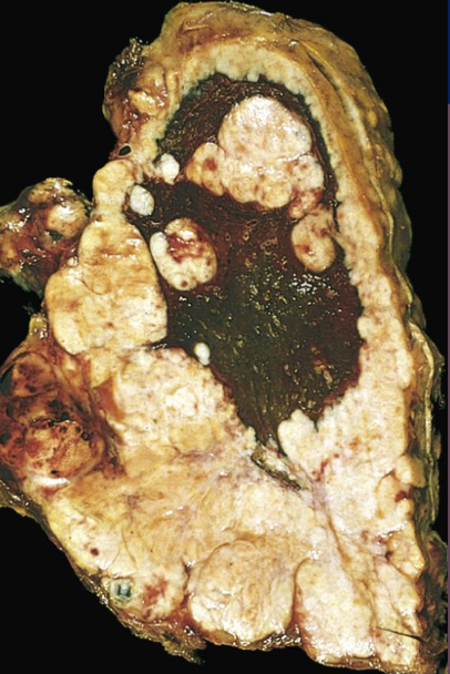<p>Mesotelioma morfología</p>