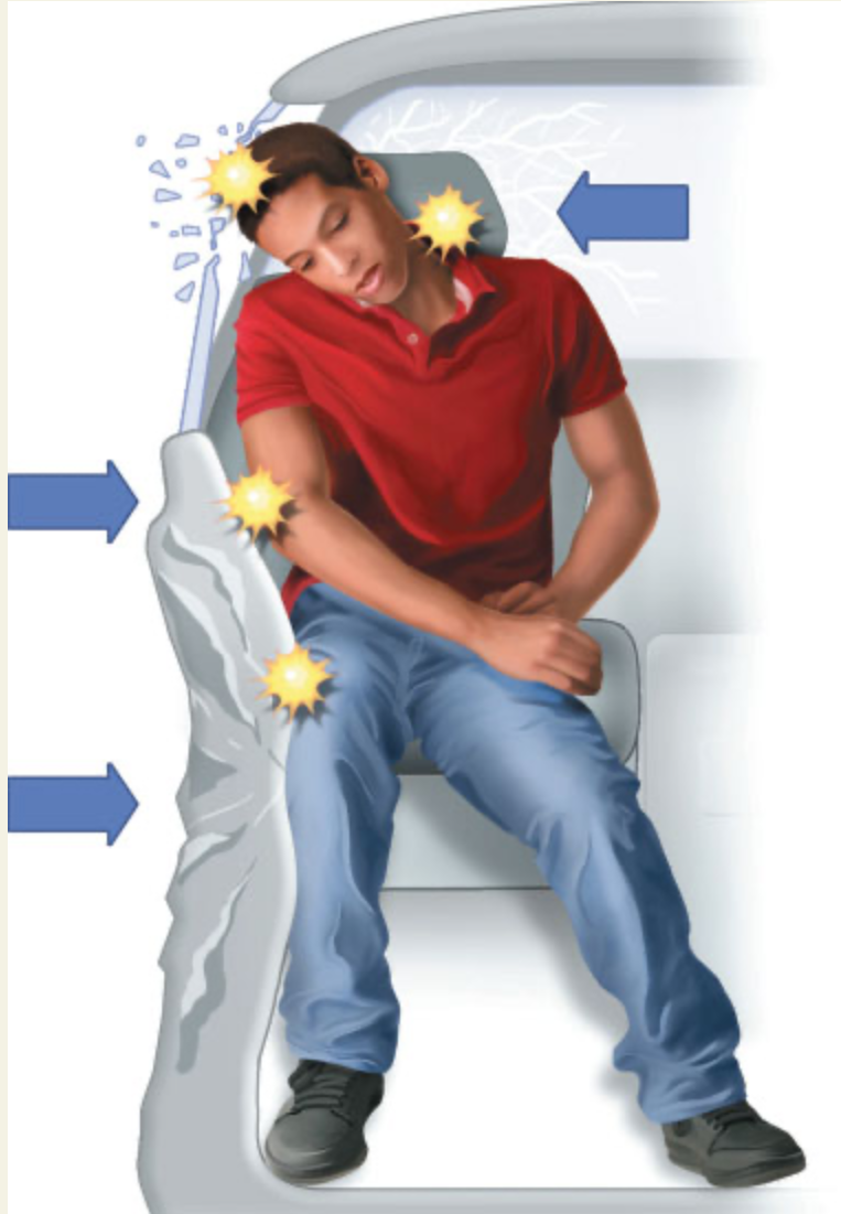 <p>The body is pushed laterally, causing injuries to the neck; head, chest, abdomen, pelvis, and thighs may be struck directly (causing skeletal and internal injuries.)</p>