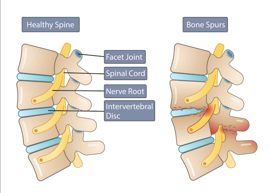 <p>Due to Wolff’s law, in the event of increased use of bones (e.g bending back too much):</p><ul><li><p>Bones can rub against each other, causing spurred edges called <strong><em><u>osteophytes</u></em></strong></p></li><li><p><em>e.g osteophytic lipping of the vertebrae</em></p></li></ul><p></p>