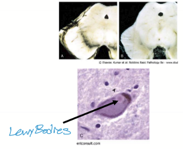 <p>Lewy Bodies form and are made of misfolded alpha synuclein. There is also a loss of dopaminergic neurons, causing hypokinetic presentaions. Treatement usually begins at this point. </p>