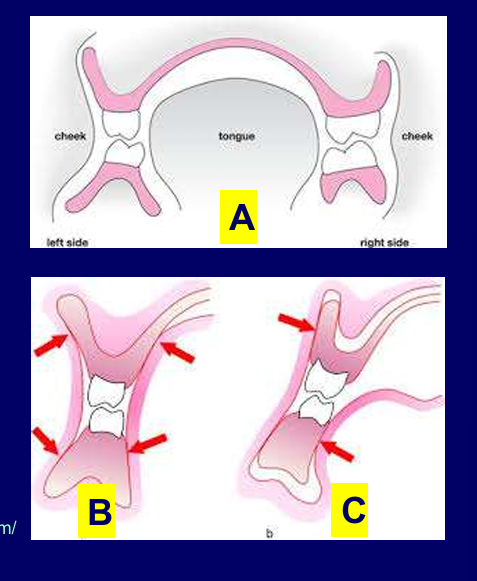 <p>How can muscular control keep dentures from displacement?</p>