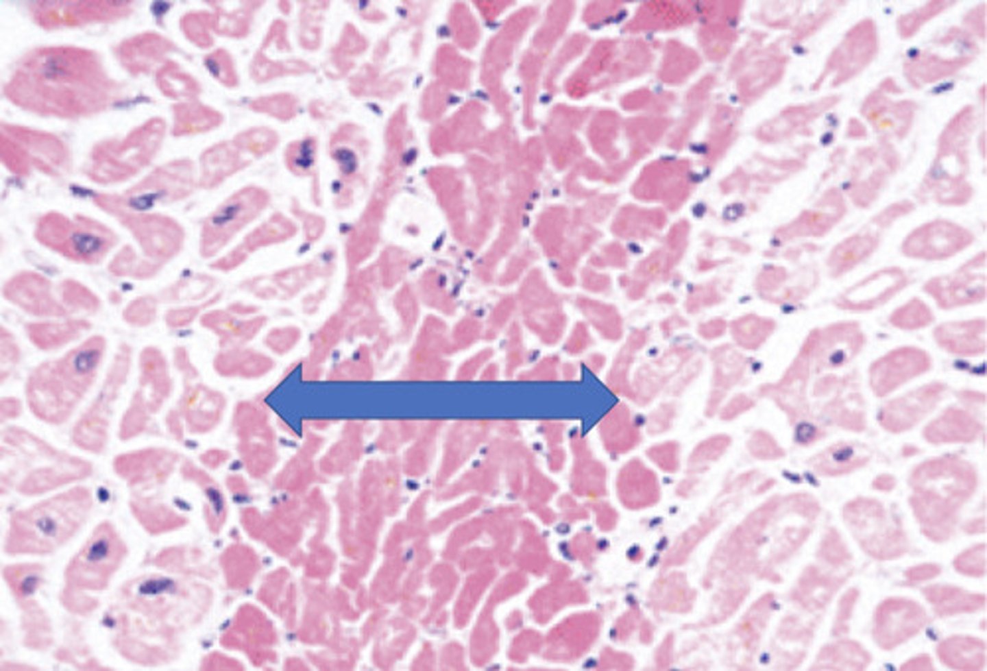 <p>What type of necrosis is seen in this cardiac muscle?</p>