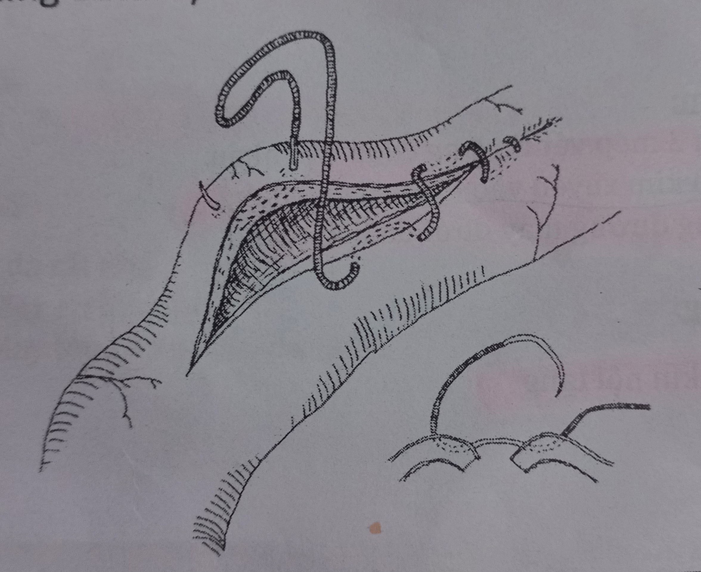 <p>Đường may Cushing</p>