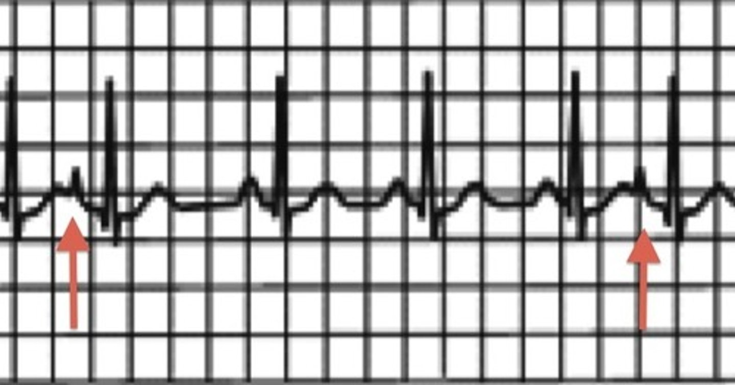 <p>- Irregular heart rhythm caused by an ectopic focus in atrium, distorting the P-wave</p><p>- Causes: stress, fatigue, caffeine, tobacco, alcohol, electrolyte issues</p><p>- S/S: heart “skips a beat”</p><p>- Treatment: withhold stimulants, administer beta blockers</p><p>- In patients with previous heart disease who are having PACs it could indicate electrical concerns in the ventricle that precipitates more serious issues!</p>