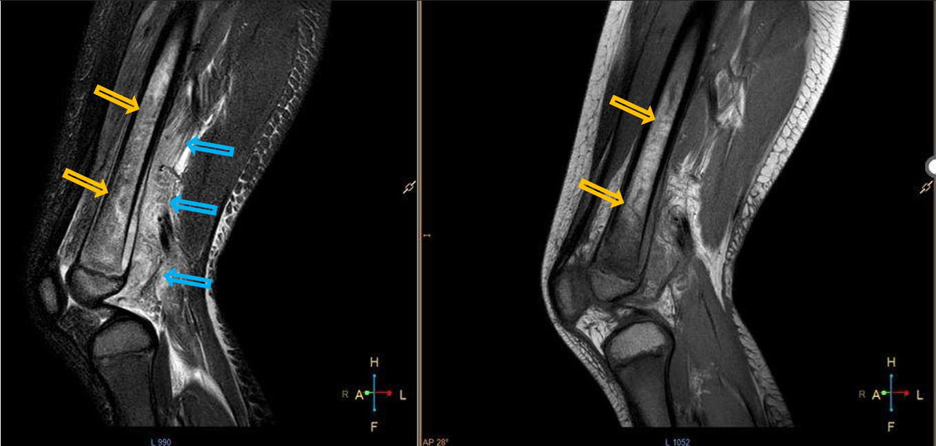 <p>Patient history: swollen and painful area above the knee in a young adult</p><p>Modality: left – fatsat Proton Density (PD) MRI; right – PD MRI</p><p>Region: knee, sagittal views</p><p>Radiologic sign: Bone marrow hyperintensity detected in the middle and distal diaphysis and in the distal metaphysis of the femur due to edema (yellow arrows), significant periosteal reaction and edema in the sorrounding soft tissue (blue arrows – extensive hyperintensity in the sorrounding soft tissue)</p><p>Diagnosis: acute osteomyelitis of the femur</p>