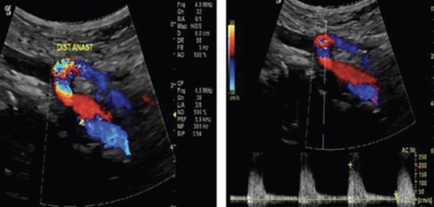 <p>Inflow artery</p><p>Proximal anastomosis</p><p>Length of graft</p><p>Distal anastomosis</p><p>Outflow artery</p>