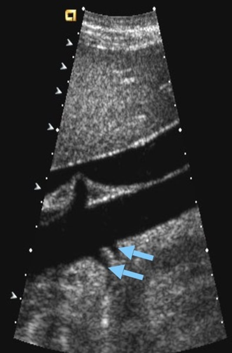 <p>Branch off main renal artery or aorta</p><p>Supply small portions of renal parenchyma.</p><p>Can be single/multiple and unilateral/bilateral</p><p>If stenotic, can result in HTN</p>