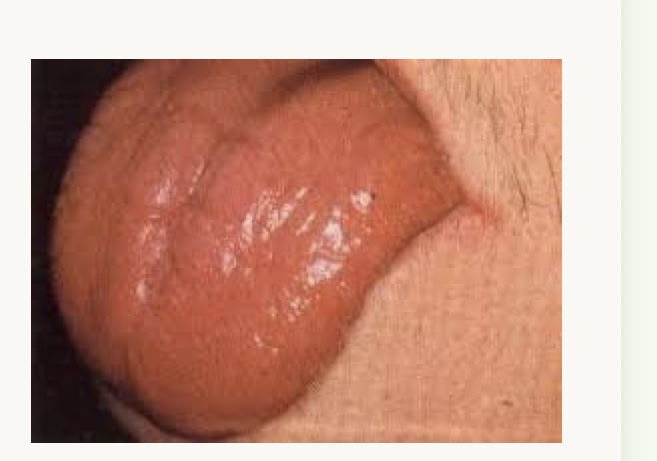 <p>what is this condition and what vitamins is this person likely deficient in?</p>