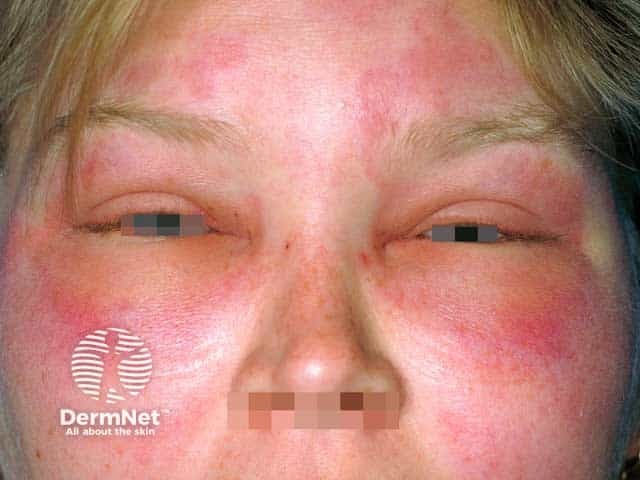 <p>Angioedema</p>