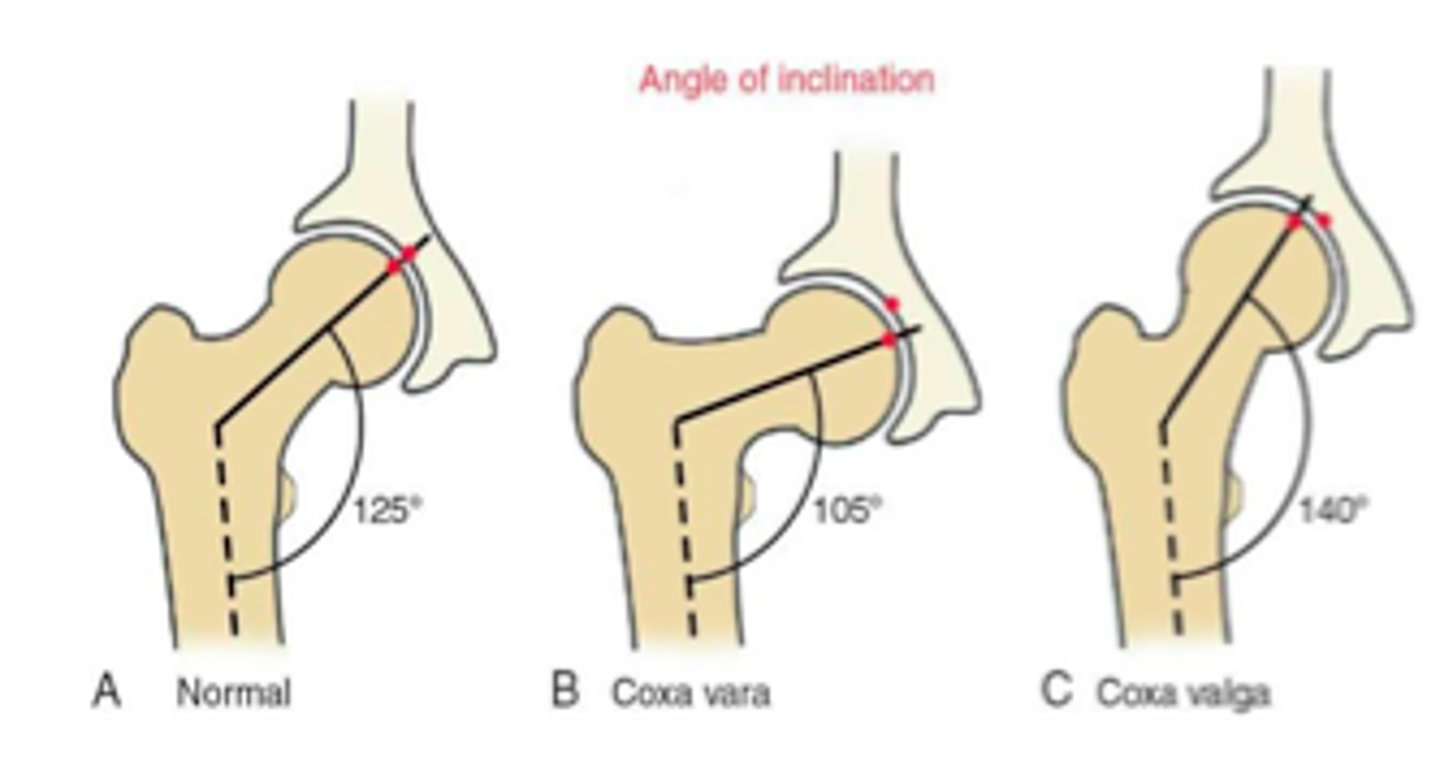<p>angle between the femoral neck/head and the femoral shaft (frontal plane)</p><p>infant = 150-175 degrees</p><p>adult = 125 degrees (110-144 range)</p>