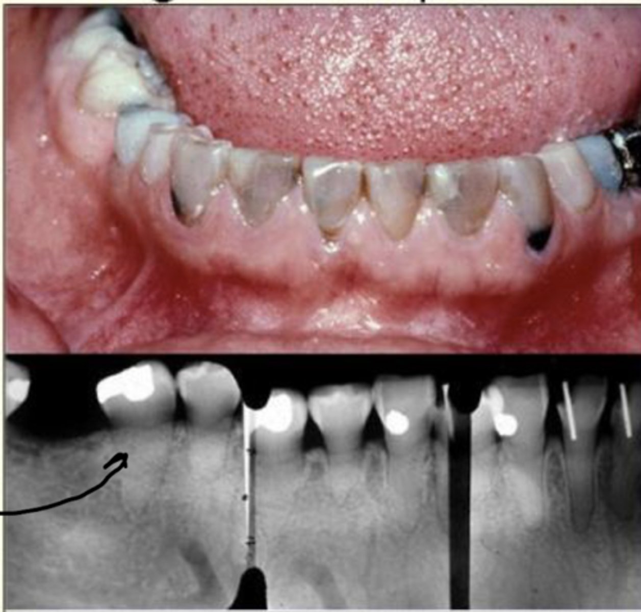<p>- Discolored teeth (yellow/brown/grey)</p><p>- Lack of enamel, exposed dentin</p><p>- Bulbous crowns</p><p>- Obliterated pulp chamber</p><p>- Short roots</p>