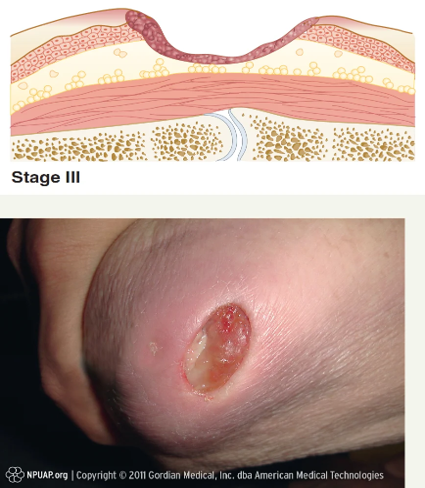 <p>Full- thickness skin loss</p><p>Deep crater </p><p>Adipose tissue is exposed </p><p>No slough or eschar present</p>