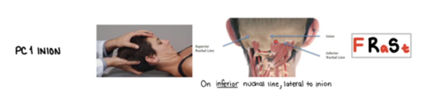 <p>F Ra St</p><p>on the inferior nuchal line, lateral to the inion</p>