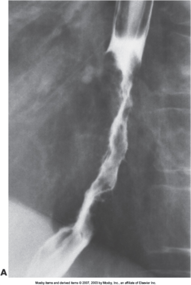<p>irregular column of barium entering stomach with peak like projections of barium -&gt; concerning for malignancy</p>