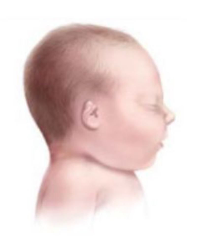 <p>Location: Pinna</p><ul><li><p>Small pinna with or without landmarks</p></li></ul><p></p>