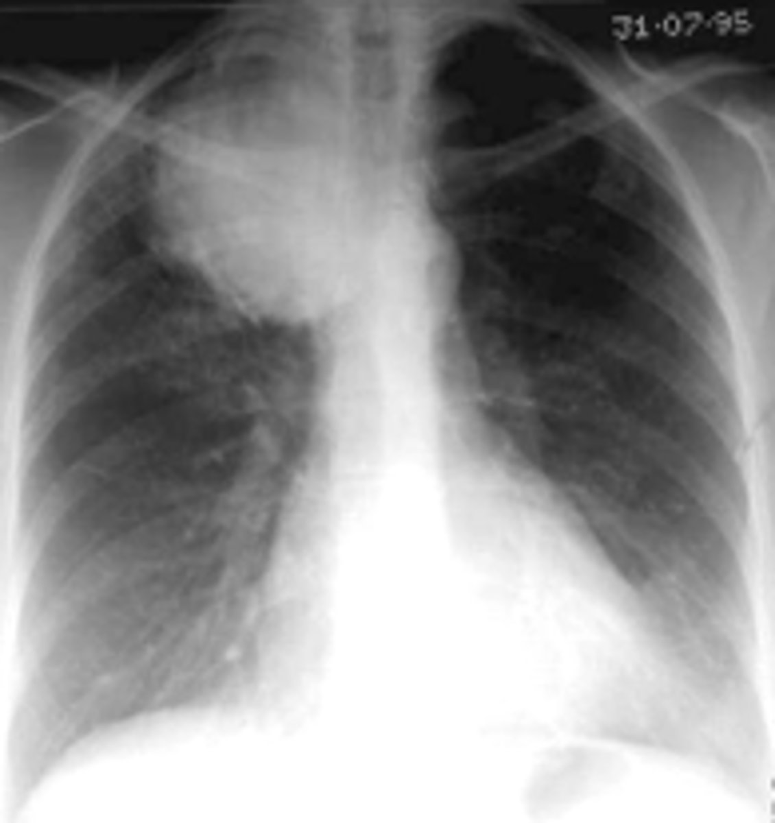 <p>-Arise in the superior sulcus of the lung as an apical soft tissue mass.</p><p>-Frequently invade the chest wall and the brachial plexus. Rib destruction common.</p><p>-Symptoms may include shoulder, arm and hand pain or weakness – T1 distribution most commonly.</p>
