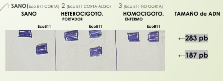 <p><strong><mark data-color="yellow" style="background-color: yellow; color: inherit;">Corta al ADN sano</mark></strong>, quedando menor tamaño del ADN</p><p></p><p>Anemia falciforme. Homocigoto (ambas copias están mal)= No corta nada</p><p>Portador anemia falciforme. Heterocigoto (una de las copias esta mal)= Corta una no todo</p>