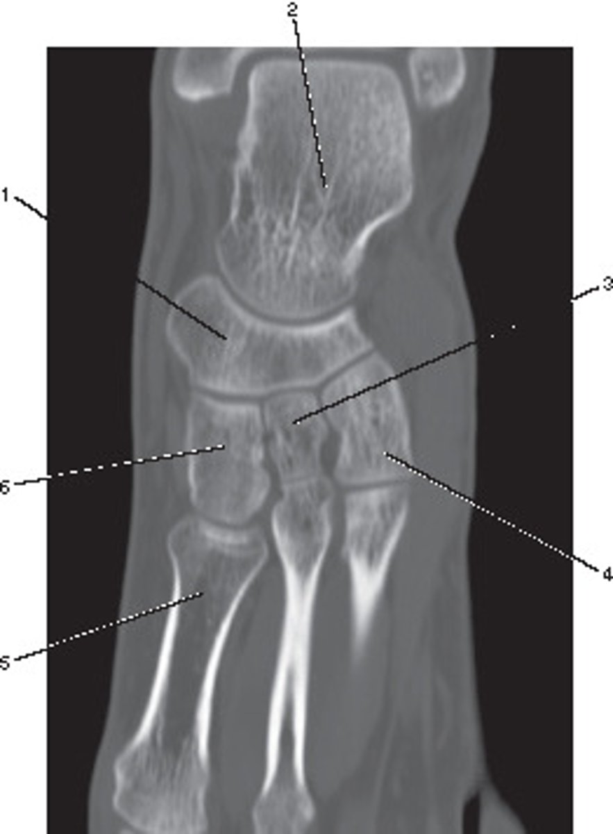 <p>This anatomic plane can best be described as the:</p>