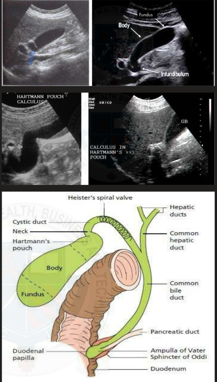 <p>Seen at the neck fo the gallbladder </p><p>Appear as a little pocket and can often catch gallstones within </p>